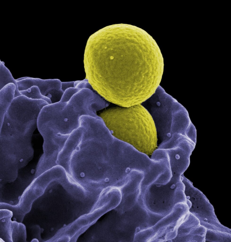 MRSA, Ingestion by Neutrophil Description: MRSA (yellow) being ingested by neutrophil (purple)
